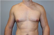 Male Breast Reduction Before Photo by Ellen Mahony, MD; Westport, CT - Case 46041