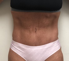 Tummy Tuck After Photo by Mark McRae, MD, FRCS(C); Burlington, ON - Case 46305