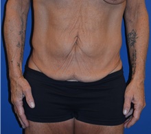 Tummy Tuck Before Photo by Mark McRae, MD, FRCS(C); Burlington, ON - Case 46305