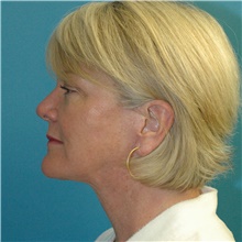 Facelift After Photo by Scott Sattler, MD,  FACS; Seattle, WA - Case 46372