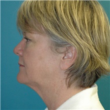 Facelift Before Photo by Scott Sattler, MD,  FACS; Seattle, WA - Case 46372
