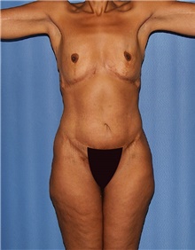 Body Lift Before Photo by Siamak Agha, MD PhD FACS; Newport Beach, CA - Case 46680