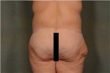 Body Lift After Photo by Ellen Janetzke, MD; Bloomfield Hills, MI - Case 46727