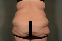 Body Lift Before Photo by Ellen Janetzke, MD; Bloomfield Hills, MI - Case 46727
