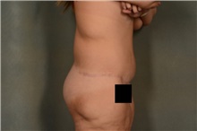 Body Lift After Photo by Ellen Janetzke, MD; Bloomfield Hills, MI - Case 46727