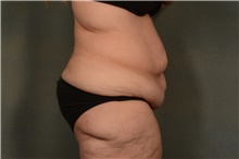 Body Lift Before Photo by Ellen Janetzke, MD; Bloomfield Hills, MI - Case 46727