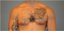 Male Breast Reduction Before Photo by Keyian Paydar, MD, FACS; Newport Beach, CA - Case 46871