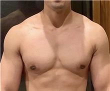 Male Breast Reduction After Photo by Keyian Paydar, MD, FACS; Newport Beach, CA - Case 46877