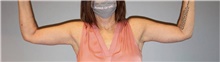 Arm Lift After Photo by Keyian Paydar, MD, FACS; Newport Beach, CA - Case 46985