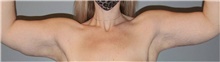 Arm Lift After Photo by Keyian Paydar, MD, FACS; Newport Beach, CA - Case 46986