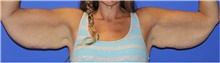 Arm Lift Before Photo by Keyian Paydar, MD, FACS; Newport Beach, CA - Case 46988
