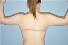 Body Lift After Photo by Keyian Paydar, MD, FACS; Newport Beach, CA - Case 47130