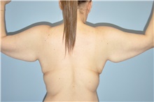 Body Lift Before Photo by Keyian Paydar, MD, FACS; Newport Beach, CA - Case 47130