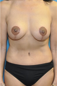 Mommy Makeover After Photo by Joshua Cooper, MD; Seattle, WA - Case 47136