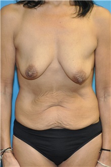 Mommy Makeover Before Photo by Joshua Cooper, MD; Seattle, WA - Case 47136