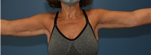Arm Lift After Photo by Derek Cody, MD, FACS; Akron, OH - Case 47241