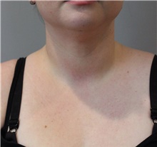 Liposuction After Photo by Ellen Mahony, MD; Westport, CT - Case 47271