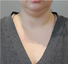 Liposuction Before Photo by Ellen Mahony, MD; Westport, CT - Case 47271