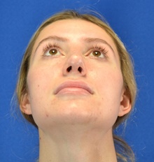Rhinoplasty After Photo by Alexander Slocum, MD, PhD; Portsmouth, NH - Case 47380