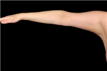 Arm Lift After Photo by Landon Pryor, MD, FACS; Rockford, IL - Case 47464