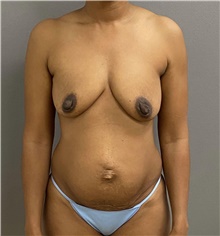 Breast Lift Before Photo by Keshav Magge, MD; Bethesda, MD - Case 47507