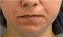 Lip Augmentation/Enhancement Before Photo by Keshav Magge, MD; Bethesda, MD - Case 47596