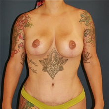 Mommy Makeover After Photo by Steve Laverson, MD, FACS; Rancho Santa Fe, CA - Case 47838