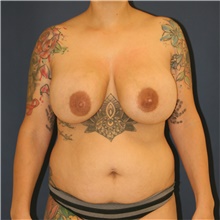 Mommy Makeover Before Photo by Steve Laverson, MD, FACS; Rancho Santa Fe, CA - Case 47838