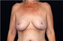 Breast Implant Removal After Photo by Landon Pryor, MD, FACS; Rockford, IL - Case 47880