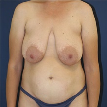 Mommy Makeover Before Photo by Steve Laverson, MD, FACS; Rancho Santa Fe, CA - Case 47901