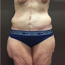 Body Contouring After Photo by Owen Reid, MD; Richmond, BC - Case 47962