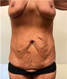 Body Contouring Before Photo by Owen Reid, MD; Richmond, BC - Case 47976