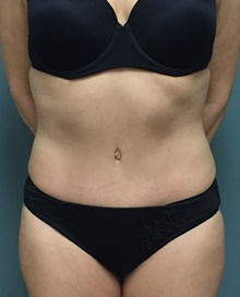 Tummy Tuck After Photo by Owen Reid, MD; Richmond, BC - Case 47992