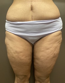 Thigh Lift After Photo by Owen Reid, MD; Richmond, BC - Case 48203