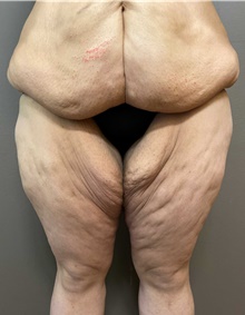 Thigh Lift Before Photo by Owen Reid, MD; Richmond, BC - Case 48203