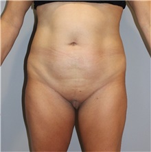 Tummy Tuck Before Photo by Ellen Mahony, MD; Westport, CT - Case 48228