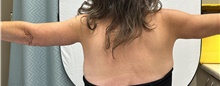 Arm Lift After Photo by Mark McRae, MD, FRCS(C); Burlington, ON - Case 48356