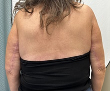 Arm Lift After Photo by Mark McRae, MD, FRCS(C); Burlington, ON - Case 48356