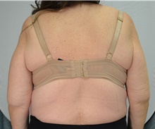 Arm Lift Before Photo by Mark McRae, MD, FRCS(C); Burlington, ON - Case 48356