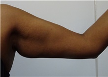 Arm Lift Before Photo by Owen Reid, MD; Richmond, BC - Case 48368