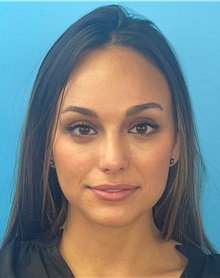 Rhinoplasty After Photo by Mark Markarian, MD, MSPH, FACS; Wellesley, MA - Case 48526