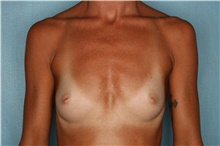 Breast Augmentation Before Photo by Kiranjeet Gill, MD; Naples, FL - Case 48627