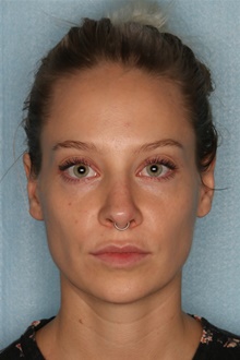 Dermal Fillers After Photo by Kiranjeet Gill, MD; Naples, FL - Case 48635