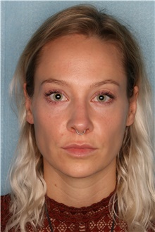 Dermal Fillers Before Photo by Kiranjeet Gill, MD; Naples, FL - Case 48635