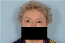 Eyelid Surgery After Photo by Ellen Janetzke, MD; Bloomfield Hills, MI - Case 48679