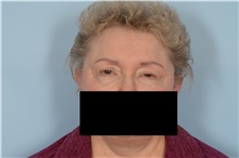 Eyelid Surgery Before Photo by Ellen Janetzke, MD; Bloomfield Hills, MI - Case 48679
