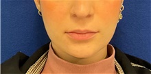 Botulinum Toxin After Photo by Munique Maia, MD; Tysons Corner, VA - Case 48753