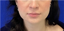 Botulinum Toxin Before Photo by Munique Maia, MD; Tysons Corner, VA - Case 48753