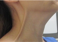 Botulinum Toxin After Photo by Munique Maia, MD; Tysons Corner, VA - Case 48757