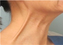Botulinum Toxin Before Photo by Munique Maia, MD; Tysons Corner, VA - Case 48757